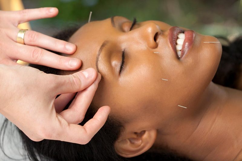 Accupuncture is a great way to treat insomnia