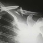 How to Mentally Recover From an Injury